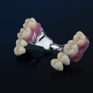Removable Partial Denture (RPD) with Precision Attachments: Bilateral Solution
